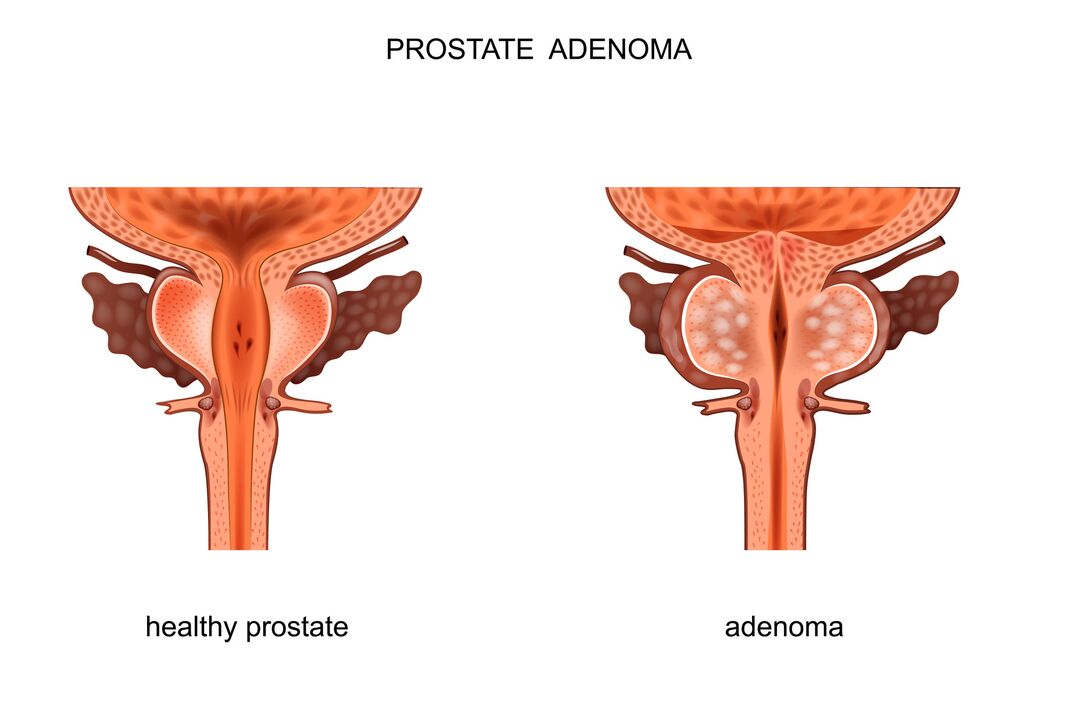 gesunde Prostata mit Adenom